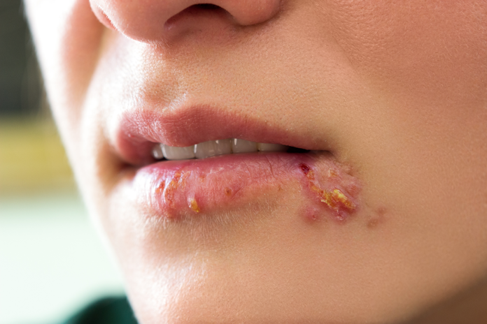 Oral Herpes