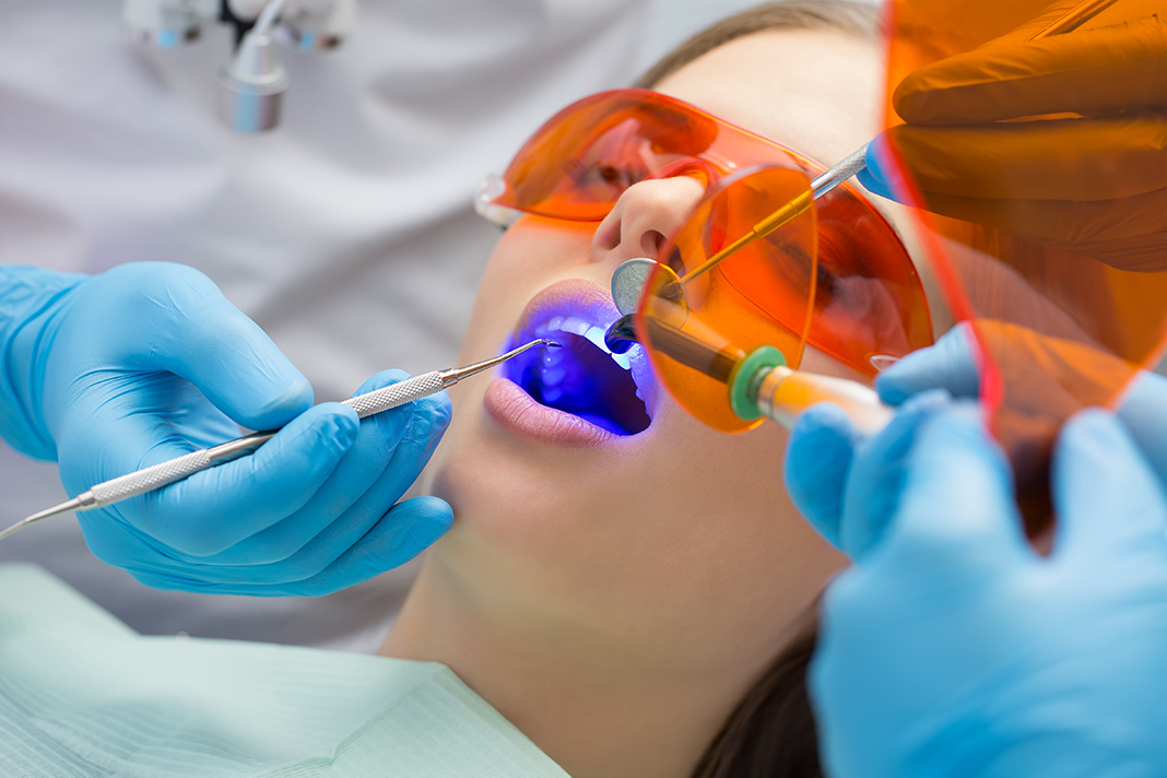 New Antimicrobial Dental Fillings May Kill Harmful Oral Bacteria