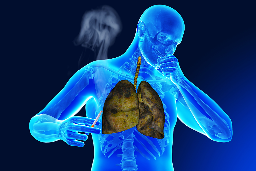 mesothelioma settlement taxable