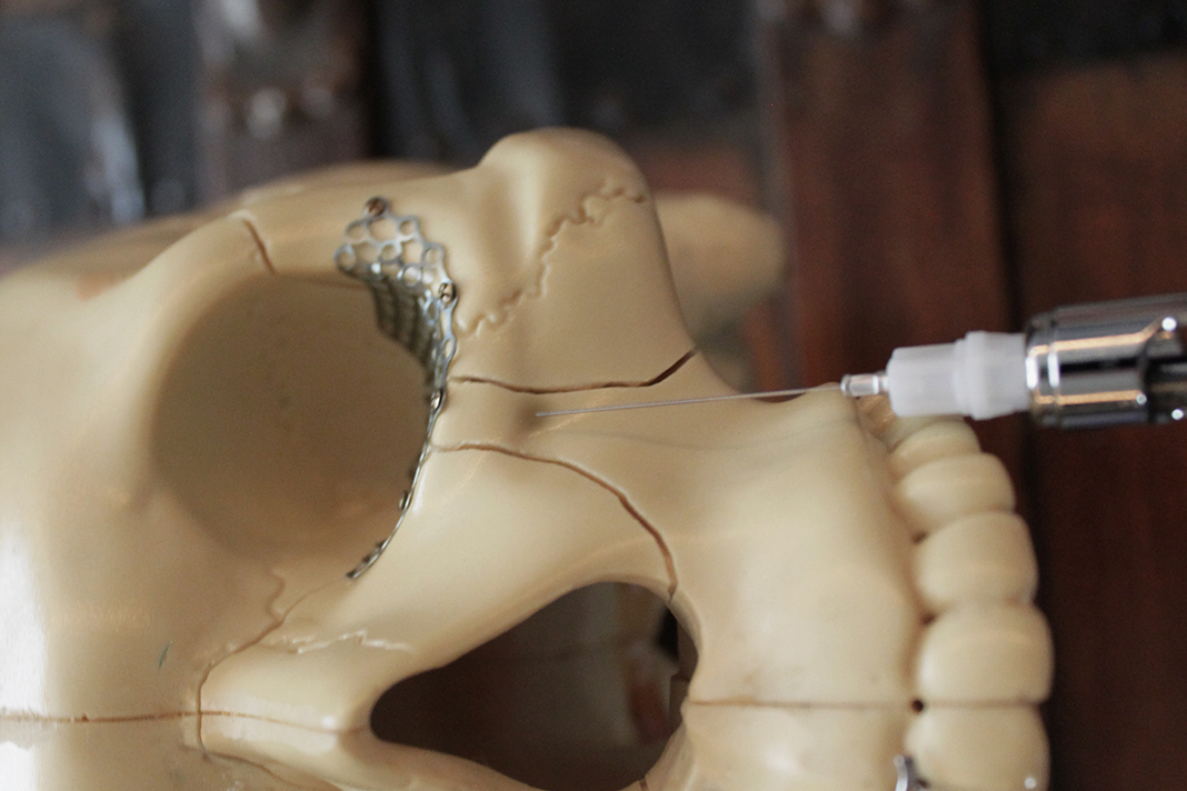 IOMy! Getting the Perfect Anesthesia Injection Today's RDH