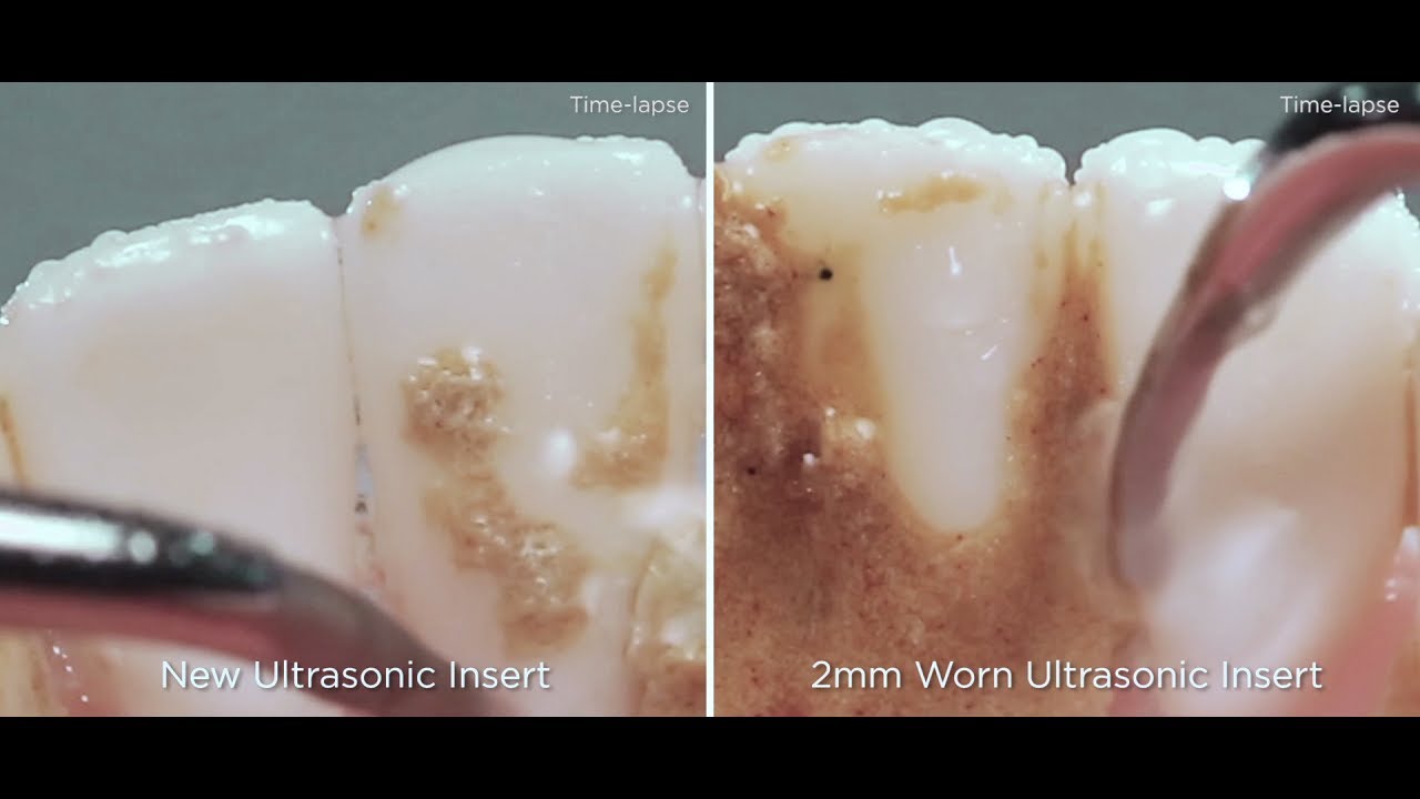 VIDEO The Impacts of Ultrasonic Insert Tip Wear Today's RDH