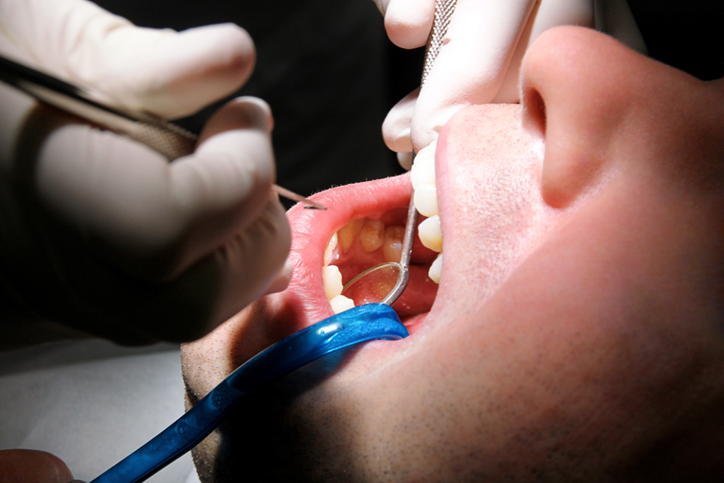 Periodontal maintenance taking the guesswork out of the 4910 today s rdh