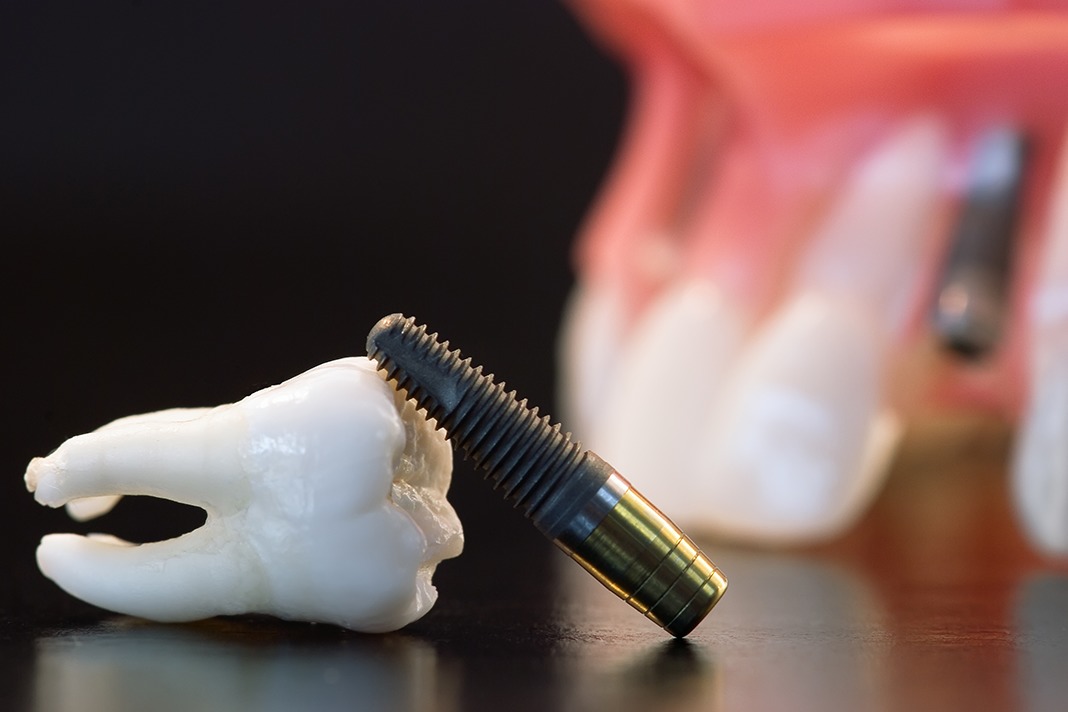 Bisphosphonate Continues to be Linked to Dental Implant Failure Today