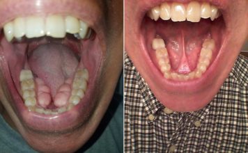 Peroxide Use In Dentistry Is It Safe For Oral Health Care Today S Rdh