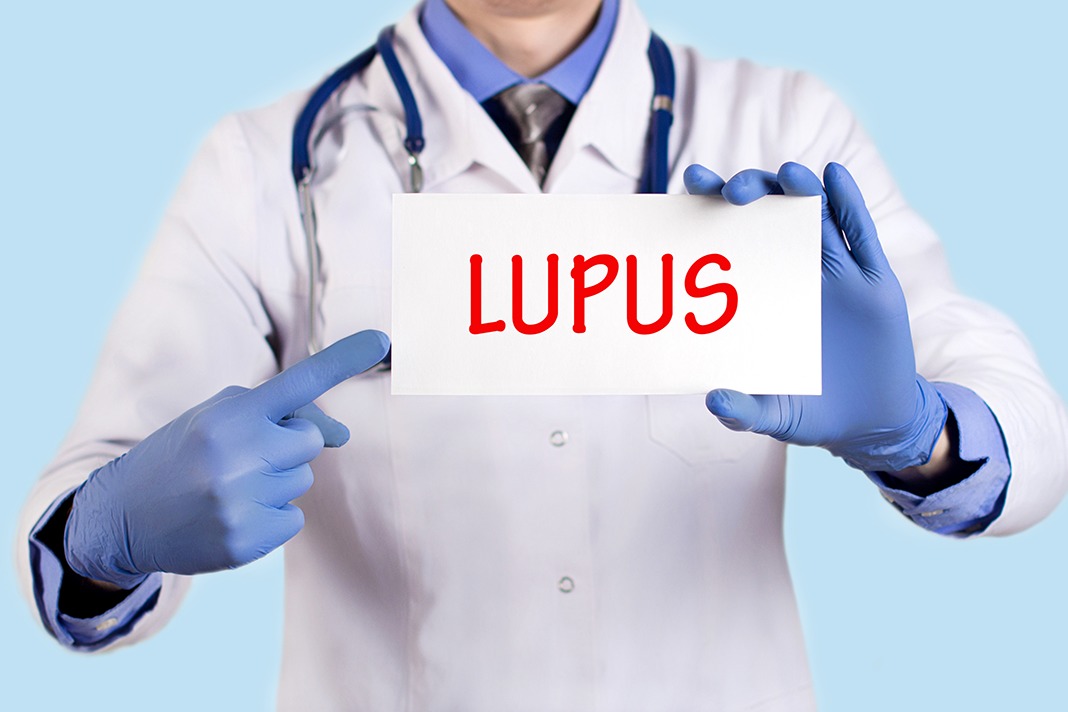 Poor Dental Hygiene Linked to Active Disease Activity in Lupus Today