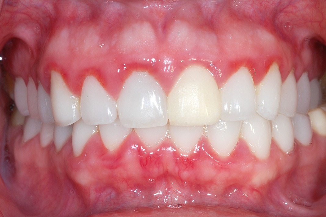 Clinical Trial Shines Spotlight on Dental Hygiene and Desquamative
