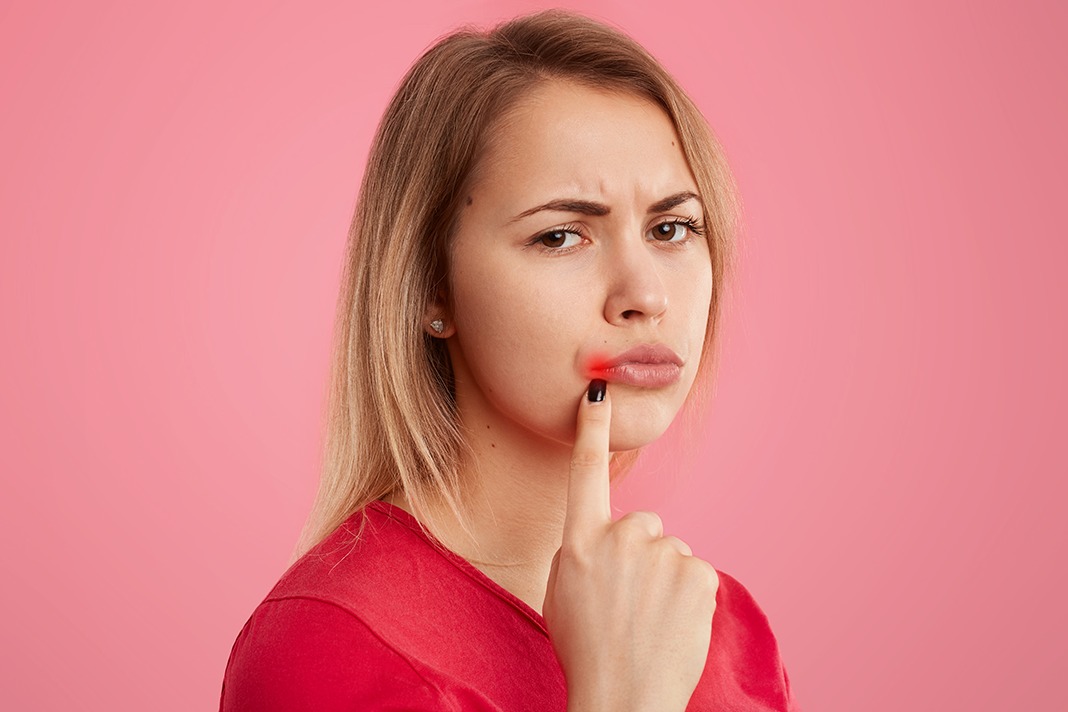 How to Tell if Your Supplements are Underdosed (2021) Mouth Ulcers or Cracks in the Corners of the Mouth