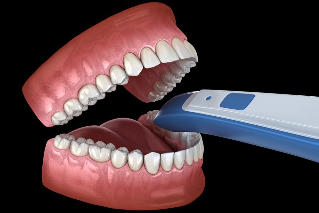 5 Tips and Tricks for Using Intraoral Digital Scanners Today's RDH