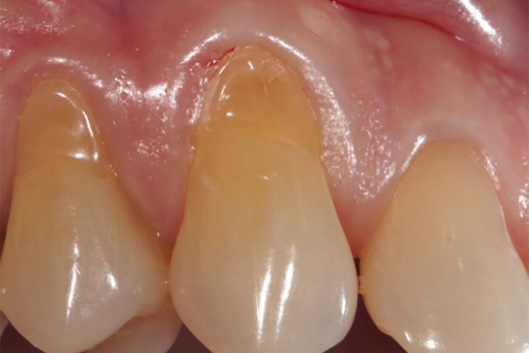 Gingival Recession When Surgical Options Should be Considered Instead