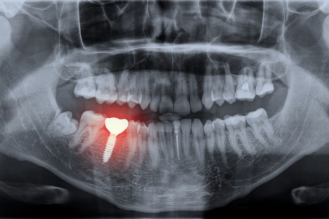 Do Dental Implants Really Look Like Teeth? Significance of