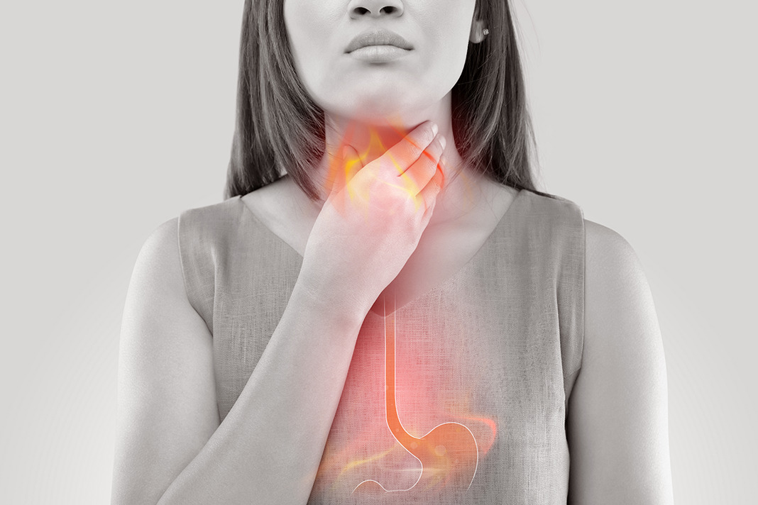 Dental Erosion Is It Heartburn, Acid Reflux, or GERD? Today's RDH