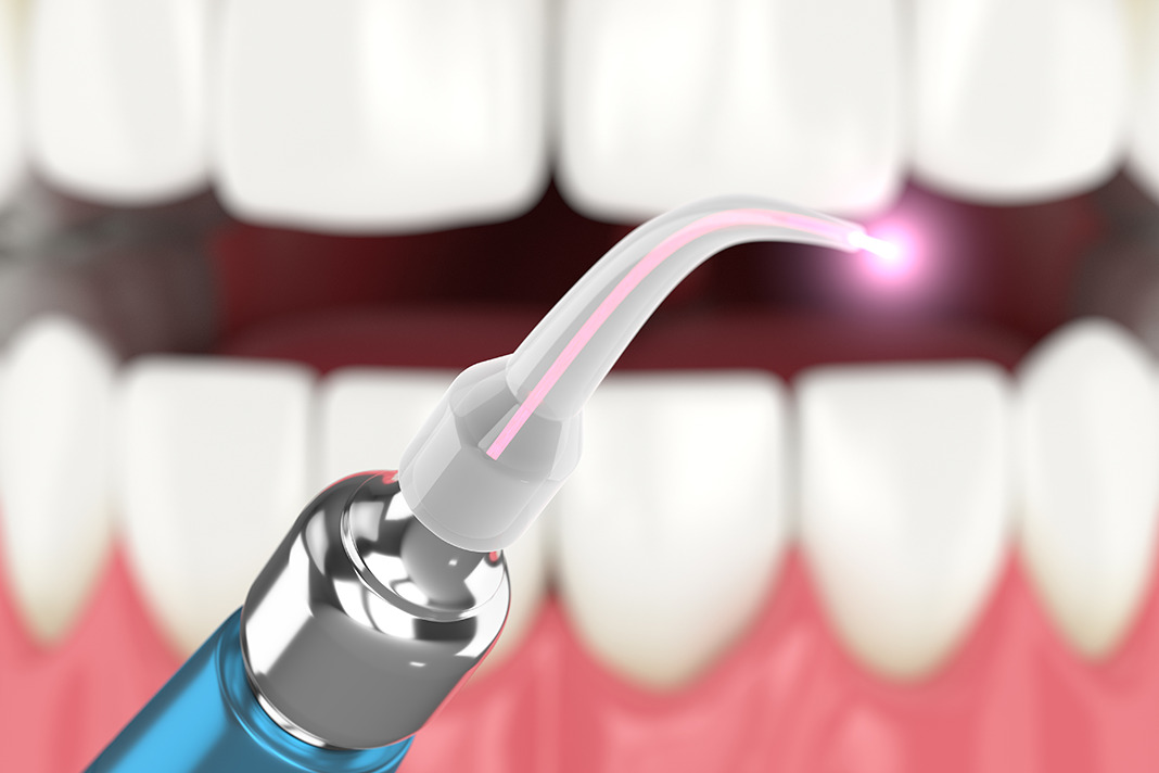 Laser Treatment during Periodontal Surgery Shows Promising Results for
