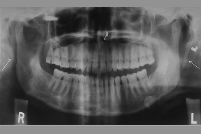 elongated calcified styloid process bilaterally