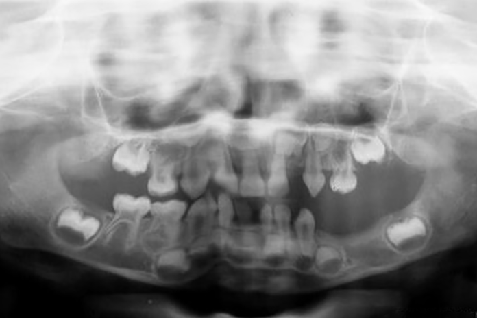 Tooth Agenesis