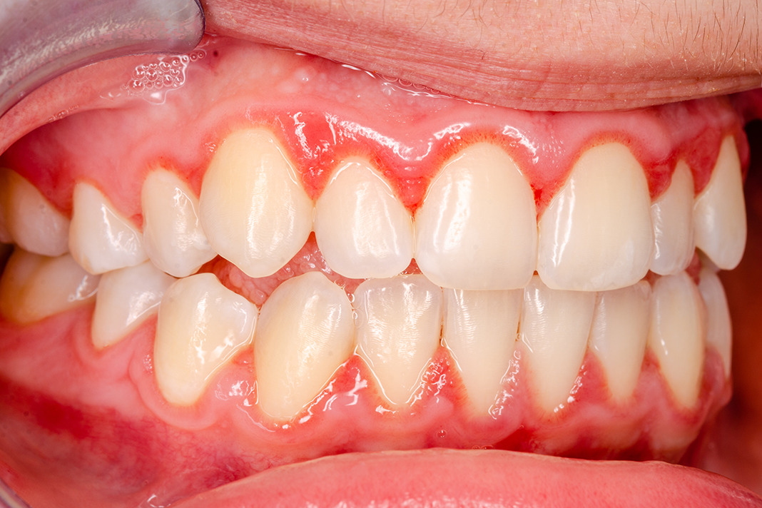 Desquamative Gingivitis Maintenance Through Proper Oral Care In Lieu