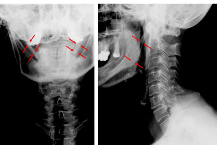 eagle syndrome dental