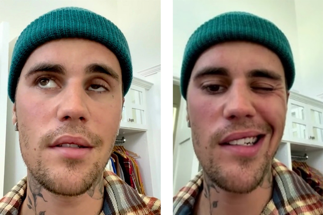 Bieber Fever Gets Serious: What RDHs Should Know about Ramsay-Hunt ...